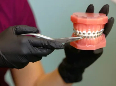 Jakie produkty spozywać po założeniu aparatu ortodontycznego
