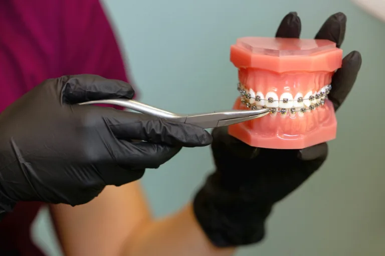 Jakie produkty spozywać po założeniu aparatu ortodontycznego